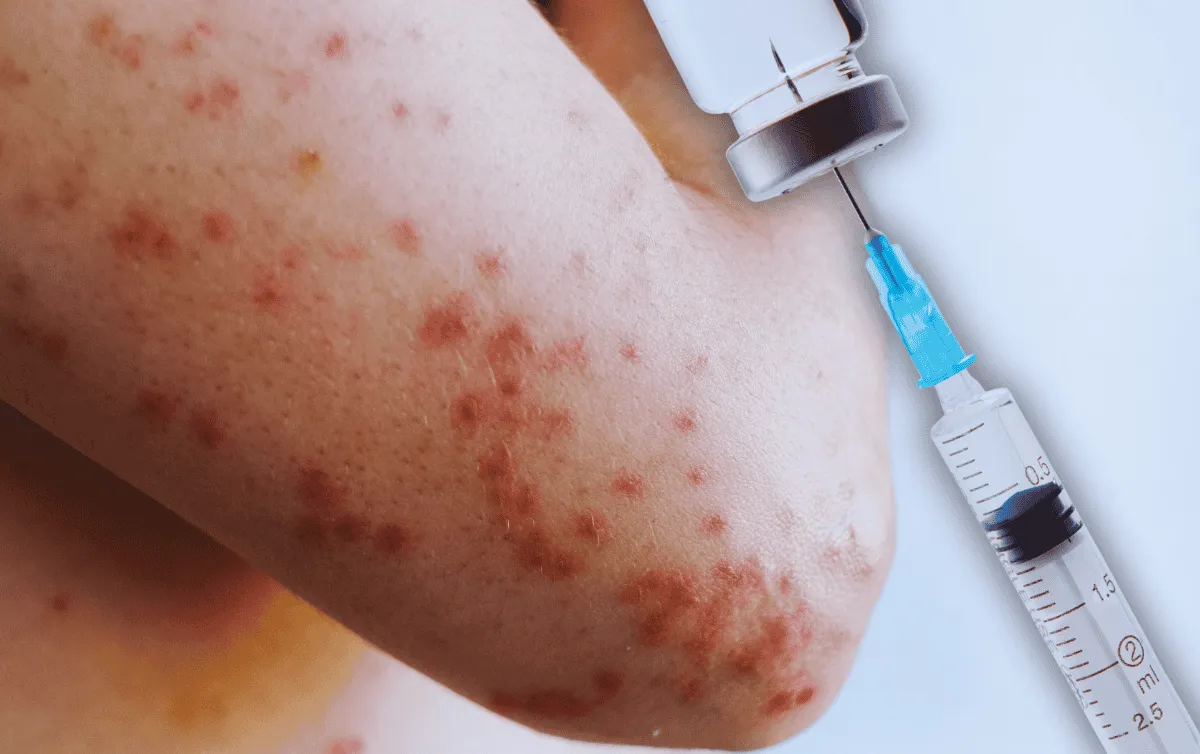 Brechas en la vacunación han impulsado la emergencia por sarampión: UNAM