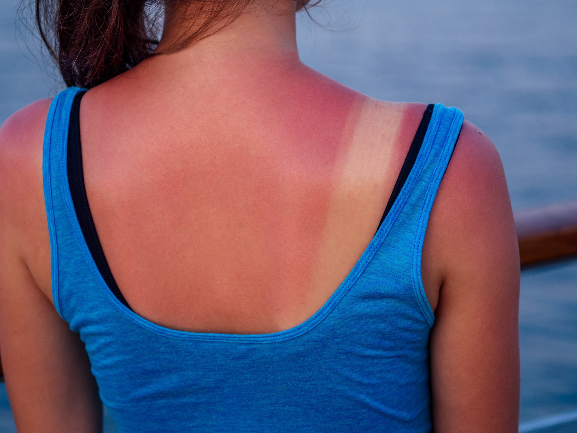 ¡No te asolees tanto! IMSS advierte por riesgo de quemaduras y cáncer de piel