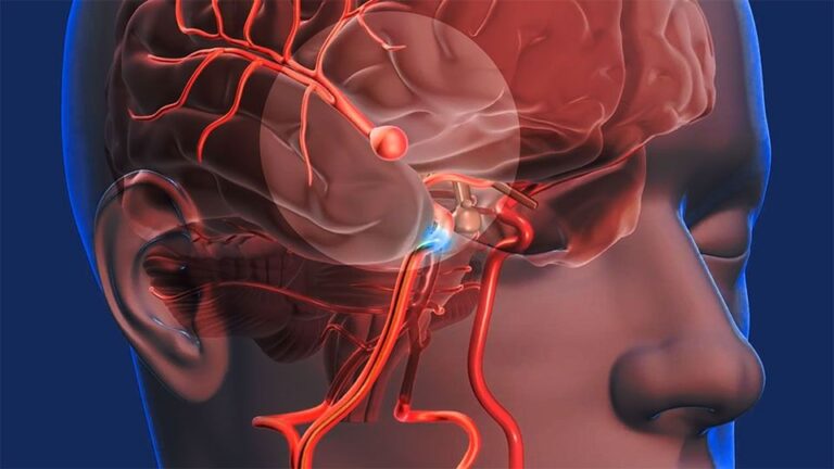 Investigan nuevo tratamiento para prevenir un segundo accidente cerebrovascular (y más)