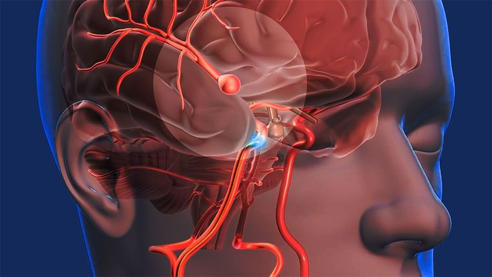 Investigan nuevo tratamiento para prevenir un segundo accidente cerebrovascular (y más)