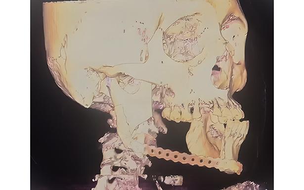 Realizan exitosa cirugía maxilofacial de alta especialidad en el IMSS Veracruz