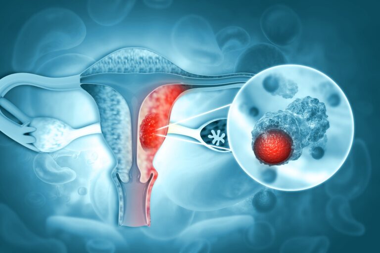 Sangrado en la menopausia no es normal: presentan nuevo tratamiento contra el cáncer de endometrio