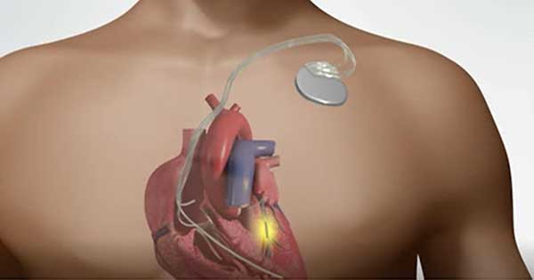 ¿Récord? Hospital Regional del ISSSTE en Jalisco realiza jornada de colocación de marcapasos
