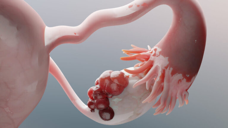 Cáncer de ovario sigue detectándose tarde, ¿cuáles son las señales de alerta?