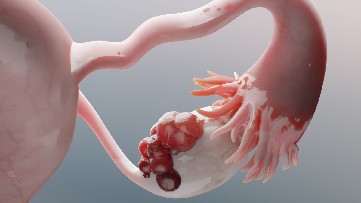 Cáncer de ovario sigue detectándose tarde, ¿cuáles son las señales de alerta?