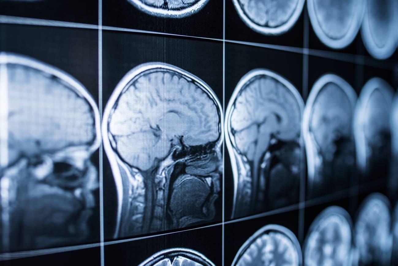 Desarrollan parche de seda que ayudaría al cerebro después de un ictus