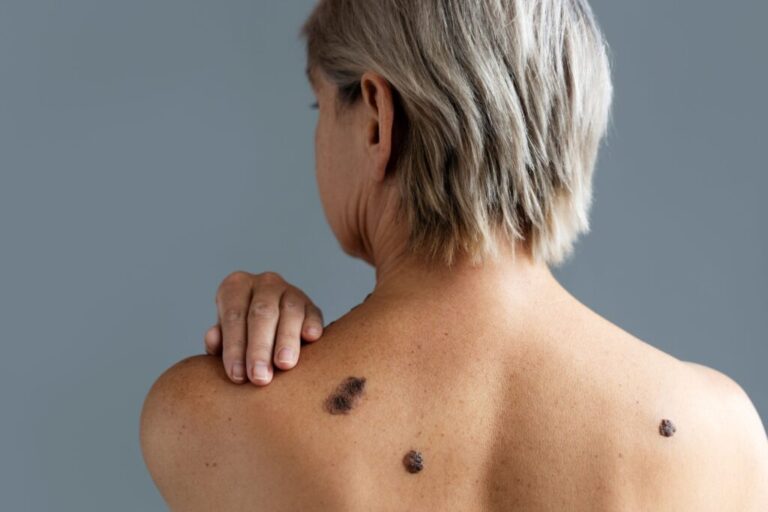 Melanoma: expertos recomiendan regla ABCDE para identificar “lunares” peligrosos