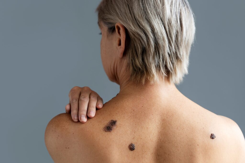 Melanoma: expertos recomiendan regla ABCDE para identificar “lunares” peligrosos
