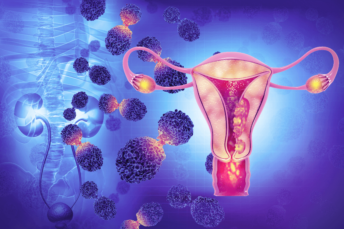 Nuevo tratamiento contra el cáncer de endometrio primario avanzado ya está disponible para mujeres mexicanas