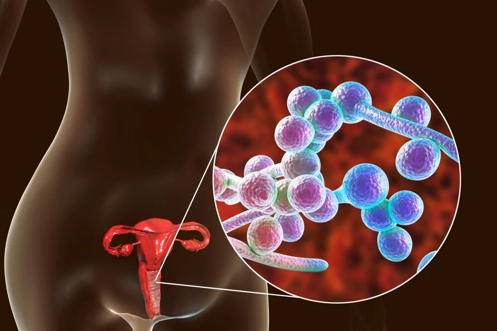 Infecciones íntimas pueden causar infertilidad en 1 de cada 4 mujeres
