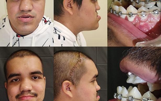 Buenas noticias: especialistas reconstruyen rostro de un joven y transforman su vida