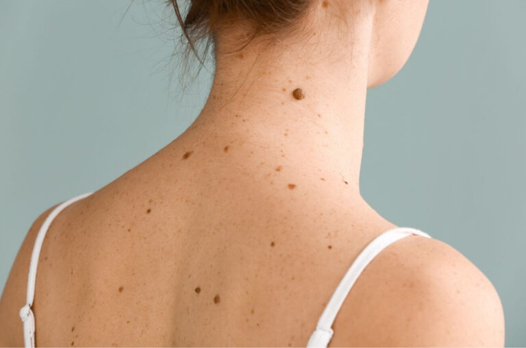 ¿Belleza o riesgo? El peligro oculto detrás de “un simple lunar”