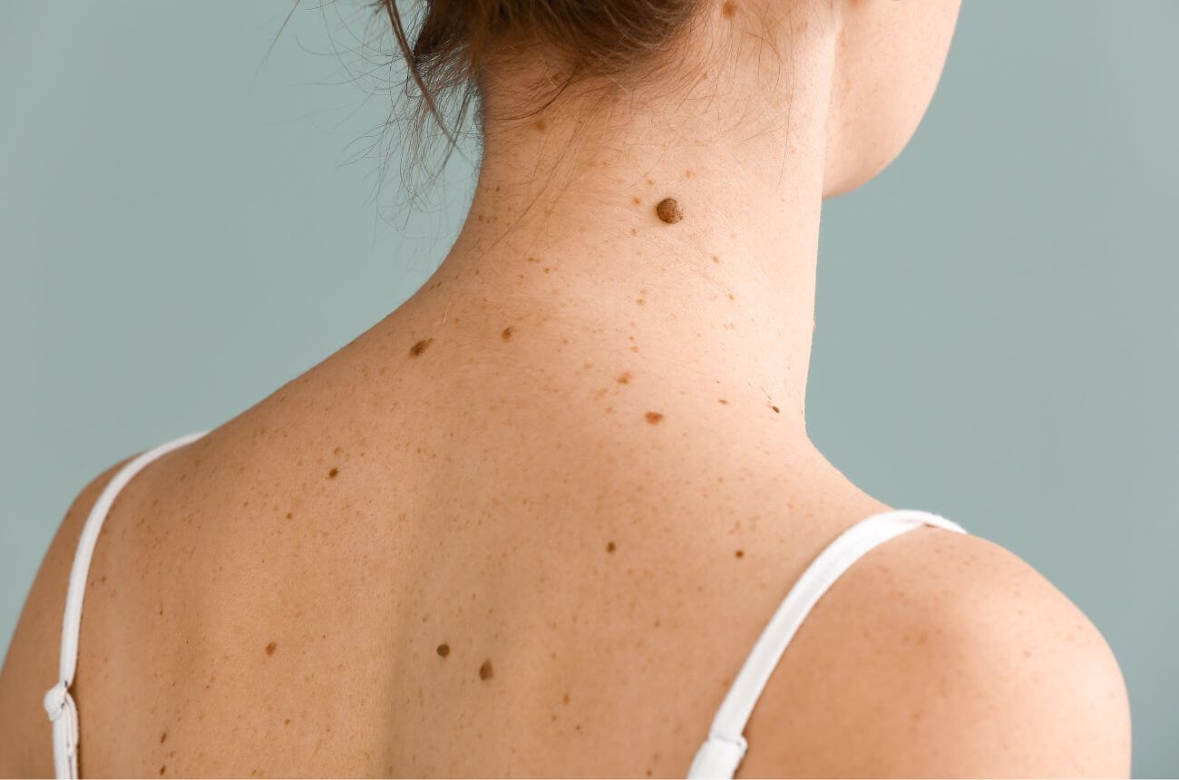 ¿Belleza o riesgo? El peligro oculto detrás de “un simple lunar”