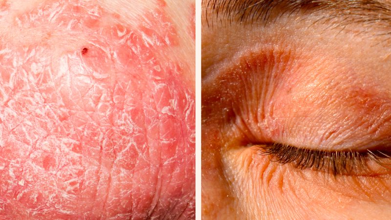 Innovación contra la psoriasis: avance científico choca con el rezago en el acceso en México