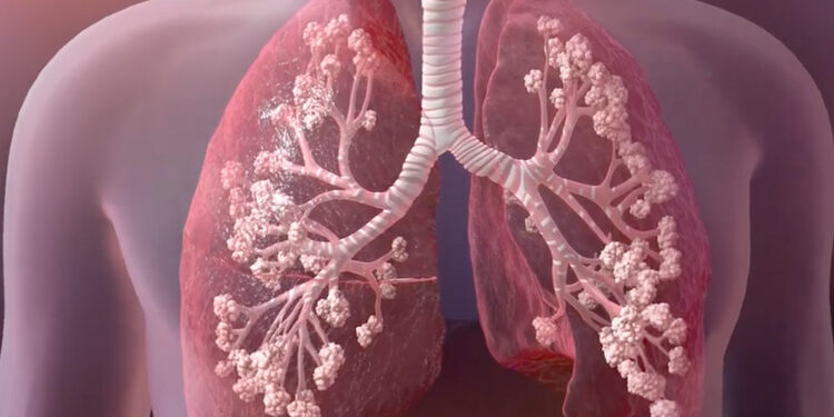 Avanza creación del Registro Nacional de Fibrosis Quística en México
