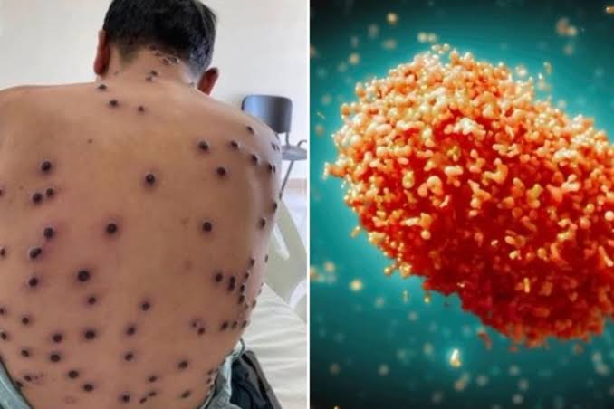 Secretaría de Salud presenta estrategia integral para el control de Mpox